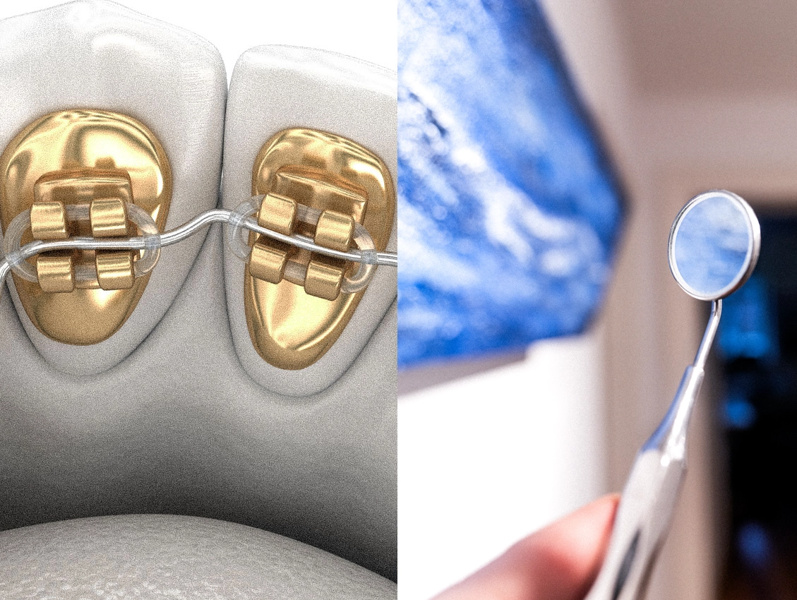 Kieferorthopaedie Erwachsene Deggendorf mit unsichtbarer Zahnspange und innenliegenden Brackets